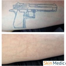 PicoStar laser Skin Medic