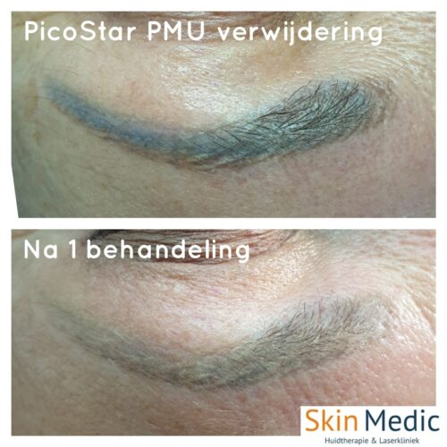 PicoStar laser PMU Skin Medic