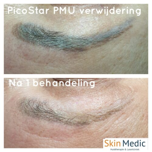 PicoStar laser PMU Skin Medic