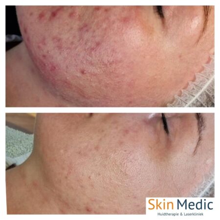 Acne Therapie Skin Medic