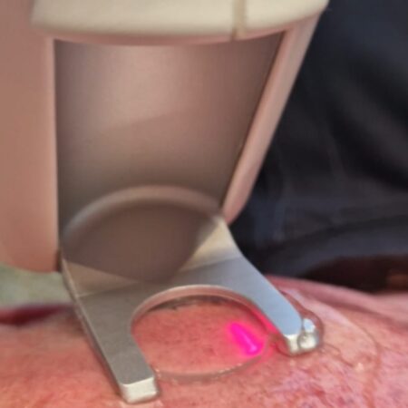 Vaatlaser behandeling Skin Medic