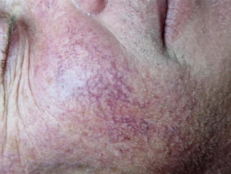 Rosacea therapie Skin Medic