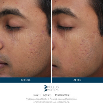 SkinPen® resultaten Skin Medic