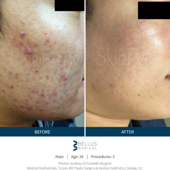 SkinPen® resultaten Skin Medic