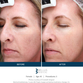 SkinPen® resultaten Skin Medic