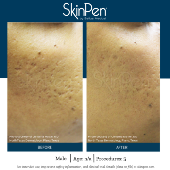 SkinPen® resultaten Skin Medic