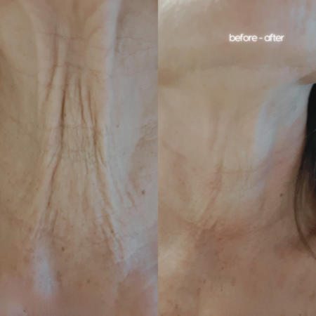 Tesla Med hals Skin Medic