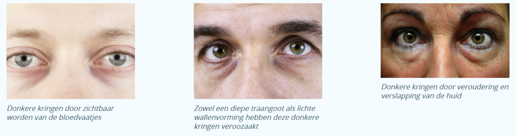 Donkere kringen onder de ogen Skin Medic