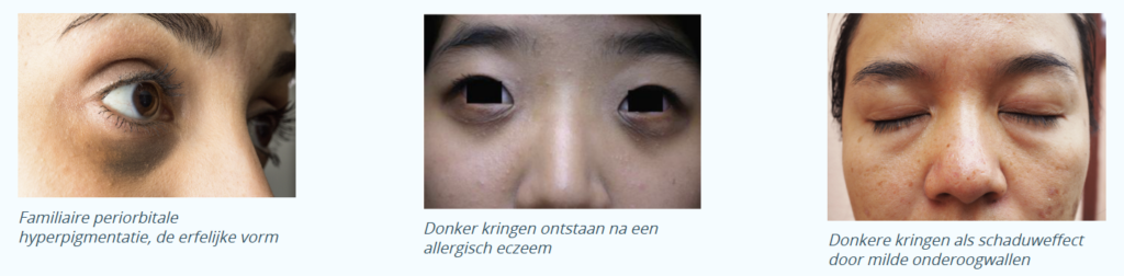 Donkere kringen onder de ogen Skin Medic