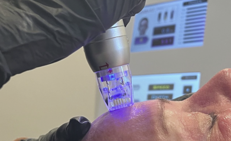 Scarlet | Sylfirm microneedling RF Skin Medic