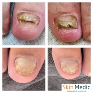 Schimmelnagels laseren Skin Medic