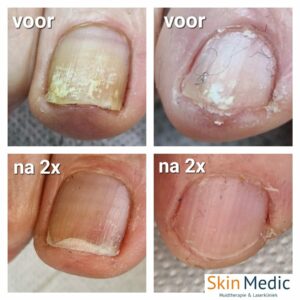 Schimmelnagels laseren Skin Medic