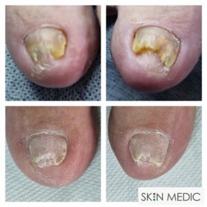 Schimmelnagels laseren Skin Medic