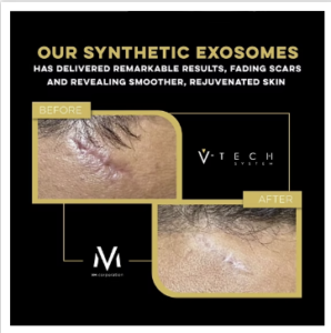 V-Tech litteken Skin Medic