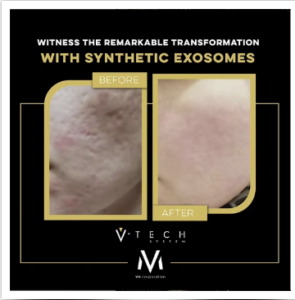V-Tech littekens verminderen Skin Medic