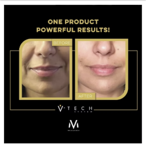 V-Tech nasolabiaal plooi verminderen Skin Tech