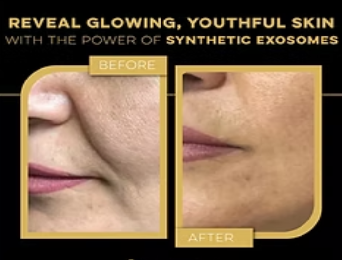 Exosomen treatment Skin Medi