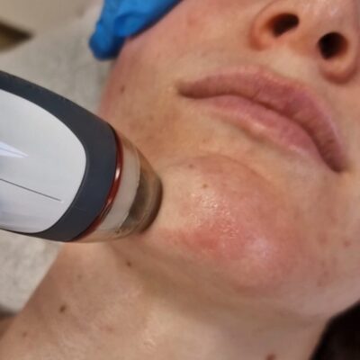 Hydra Facial - Skin Medic Hydra Facial - Skin Medic