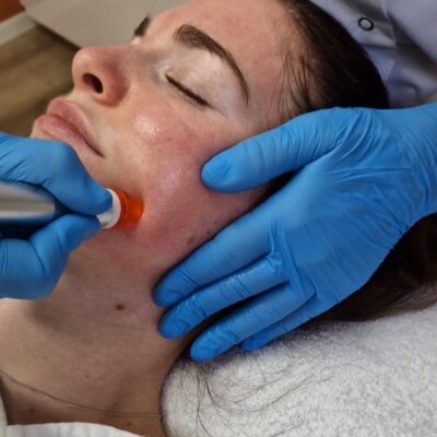 Hydra Facial - Skin Medic Hydra Facial - Skin Medic