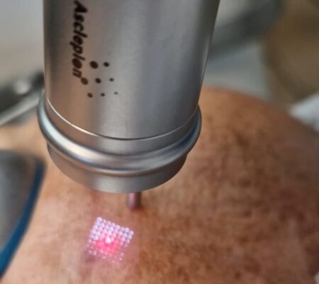 PicoStar fractionelen huidverbetering - Skin Medic PicoStar fractionelen huidverbetering - Skin Medic