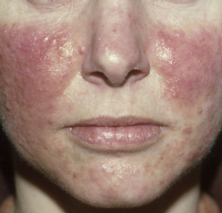 Rosacea behandeling - Skin Medic
