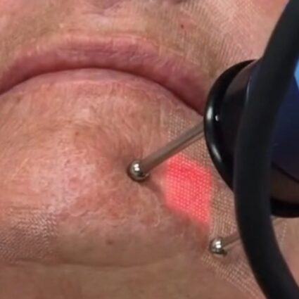 Dermablate erbium yag laser Skin Medic