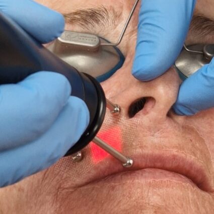 Dermablate Cool laser Skin Medic
